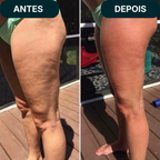 Massageador MaxConfort™  - Anticelulite e Ação Térmica!